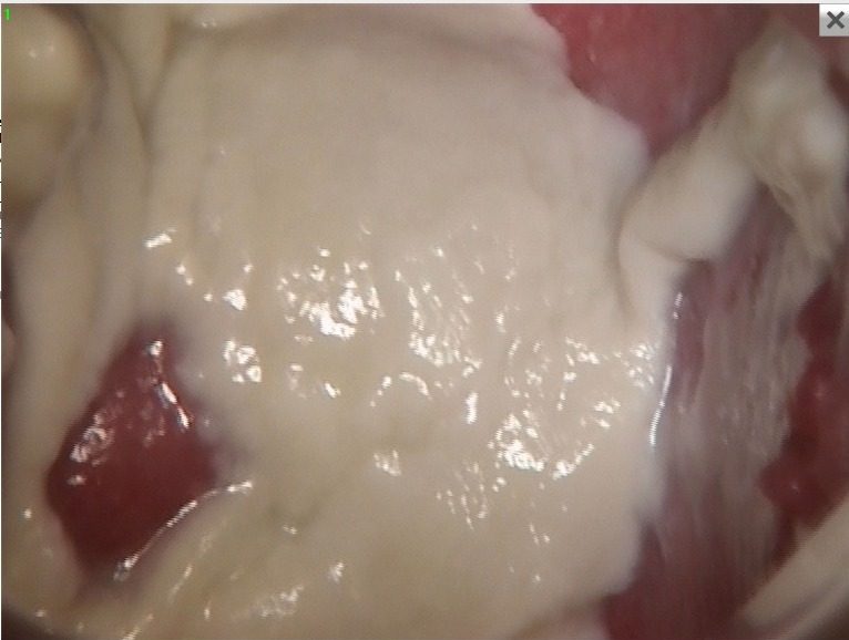Antes - CANDIDIASIS VULVOVAGINAL